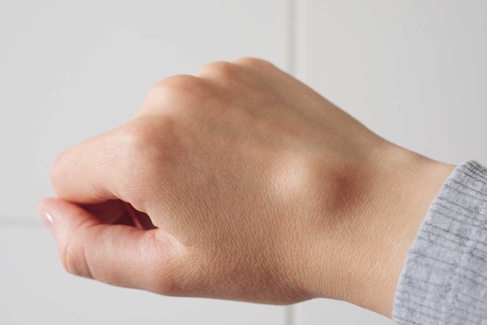 Hand mit Schwellung am Handgelenk durch ein Ganglion