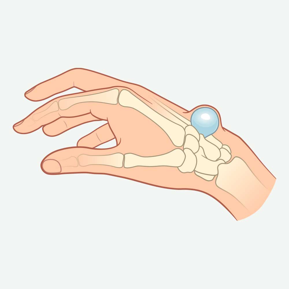 Hand mit Schwellung am Handgelenk durch ein Ganglion